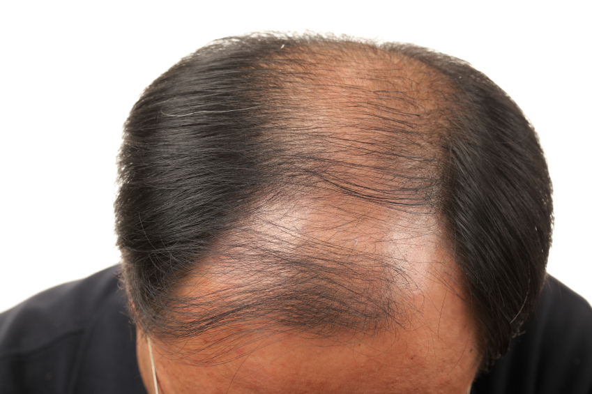 best way to regrow male hair